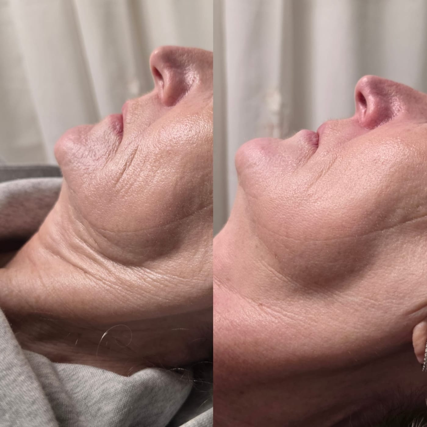 Before and after HIFU on the neck and jawline